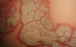 Uống thuốc nam trị vảy nến, bệnh nhân bị suy thận