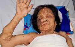 Giải cứu nữ bệnh nhân có hàng trăm khối u như 'đại bàng gãy cánh'