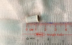 Bé trai 6 tuổi thoát chết khi hóc đầu kèn nhựa