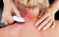 Cạo gió, giác hơi không giúp điều trị thoái hóa khớp