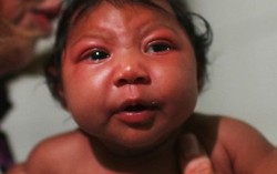 Người Đài Loan nhiễm Zika khi sang Việt Nam dự đám cưới