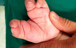 Vừa chào đời, tay chân bé đã dị dạng như càng cua