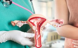 Phụ nữ ngoài 45 tuổi ít xét nghiệm sàng lọc có nguy cơ cao bị ung thư cổ tử cung