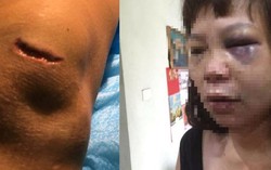 Từ vụ chồng cắt gân vợ ở Quảng Ninh: Phụ nữ cần làm gì để bảo vệ bản thân?