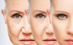U70 bức xúc vì mất 60 triệu đồng làm đẹp mà 'nhăn vẫn hoàn nhăn'