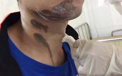 Chất tẩy bồn cầu bắn vào khiến cả vùng da hoại tử