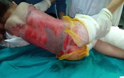 Mẹ bất cẩn, bé 3 tuổi ngã vào chậu nước sôi gây bỏng nặng