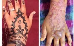 Tay phồng rộp đáng sợ vì xăm henna
