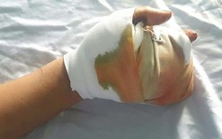 Nghịch pháo tự chế theo công thức trên mạng, 2 bé trai bị dập nát bàn tay