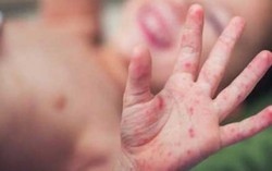 Lý giải nguyên nhân dịch tay chân miệng diễn biến bất thường