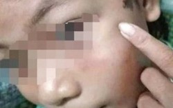 Nghi án bé gái thiểu năng bị công an viên đánh bầm tím vì trộm 50.000 đồng