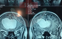 Bị trầm cảm, mất ngủ triền miên nên nghĩ đến u não trán