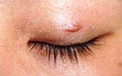 Sau khi nhấn mí, 2 mắt xuất hiện u hạt do nhiễm trùng 