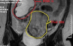 Phát hiện u nang buồng trứng xoắn hoại tử sắp vỡ khi mang thai 16 tuần