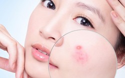 7 mẹo hay giúp phụ nữ dễ dàng xử lý mụn trứng cá