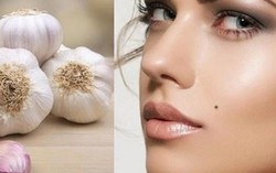 Tẩy nốt ruồi không đúng cách - ẩn họa khó lường
