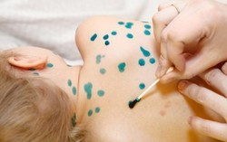 Bị thủy đậu kiêng kiểu này dễ nhiễm trùng máu