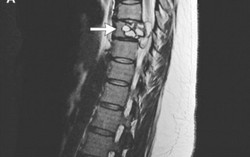 Đi khám tê chân, phát hiện sán dây cuộn trong cột sống