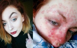 Cách trang điểm thần kì của cô nàng bị vảy nến