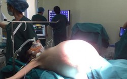 Cắt khối u buồng trứng 16kg trong bụng cô gái 22 tuổi