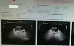 12 tuổi mang thai, nguy hiểm cả mẹ và bé