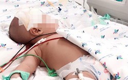 Tưởng con nhiễm siêu vi, không ngờ bị viêm màng não mủ 