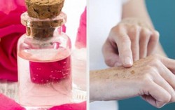 6 cách tự nhiên làm mờ đốm đồi mồi trên tay
