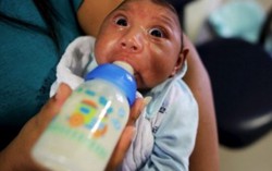 Ngoài bệnh đầu nhỏ, zika còn gây biến chứng não khác