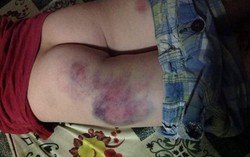 Học sinh bầm tím người ở Đăk Lăk: Báo cáo bất ngờ từ Phòng giáo dục