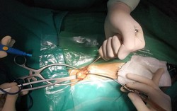 Bé 9 tuổi bị bệnh truyền nhiễm hiếm gặp chỉ vì gãi lên vết bỏng khi tự điều trị