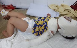 Con bỏng nặng mẹ tự đắp thuốc lá khiến bé gái nguy kịch