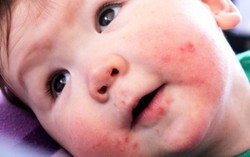 Chủng virus tay chân miệng nào có thể gây tử vong?