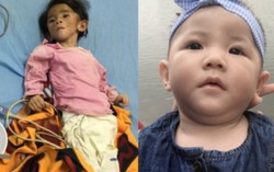 Bé gái từng suy dinh dưỡng nặng giờ lại bị teo não
