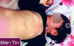 Bé trai 4 tuổi bầm tím toàn thân nghi bị cô giáo đánh