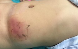 Bé 3 tuổi bị hoại tử da vùng bụng vì dán cao trị mụn