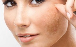 Laser trị nám, người phụ nữ bị sẹo lồi lõm trên mặt 