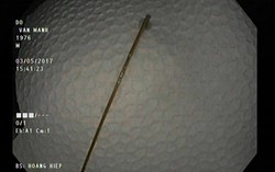 Suýt thủng ruột vì thói quen ngậm tăm
