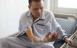 Nối thành công ngón tay bị máy xay thịt cắt lìa