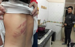 Bé trai 10 tuổi sụt 20kg vì bố đẻ mẹ kế "dạy"