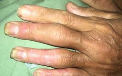 Coi chừng tàn phế khi bị viêm khớp vẩy nến
