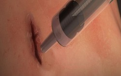 Thử nghiệm keo làm lành vết thương trên cơ thể sau 1 phút