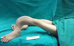Giải cứu thành công cho người đàn ông 28 năm sống cảnh 'người ếch'