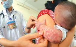 Đây là lý do nhiều trẻ chưa đến tuổi tiêm phòng vẫn mắc sởi