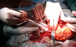 Cứu phụ nữ bị đâm thấu ngực, tràn máu màng tim
