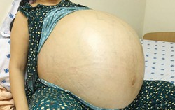 Phép màu với người phụ nữ mang khối u buồng trứng 48 lít