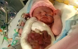 Bé gái sinh ra với ruột nằm ngoài cơ thể đã hoàn toàn khỏe mạnh 