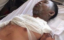 Mâu thuẫn, vợ hắt chảo dầu nóng vào mặt chồng