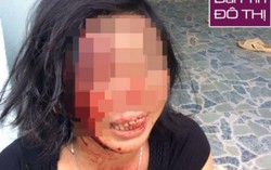 Người phụ nữ bị chồng khóa trái cửa đánh tàn nhẫn