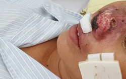 Cảnh báo bùng phát bệnh ăn cánh mũi 10 người mắc thì 4 tử vong