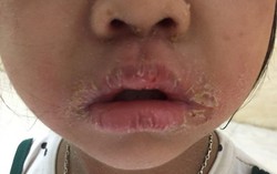 Bị bong vảy da do tụ cầu, gia đình đắp thuốc nam khiến con nặng hơn